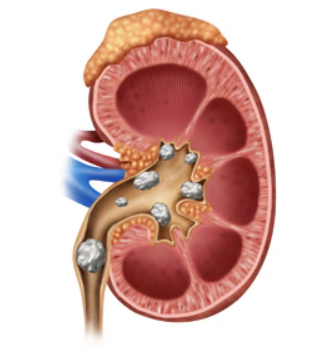 kidneyblog.png